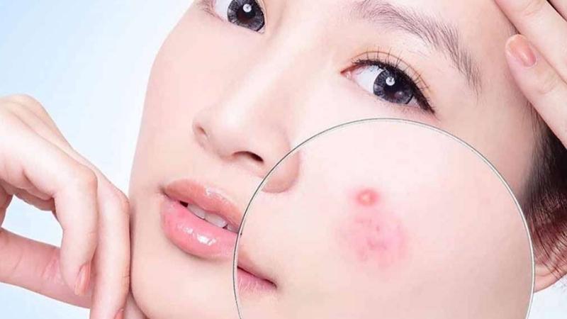 đánh giá hiệu quả trị mụn của serum charme anti - acne (1)